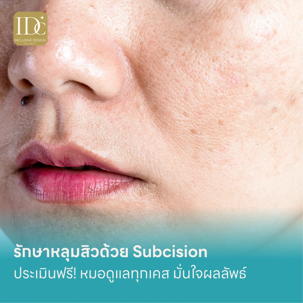 รักษาหลุมสิวด้วย Subcision แพ็กเกจ HDmall+ ที่ IDC Clinic