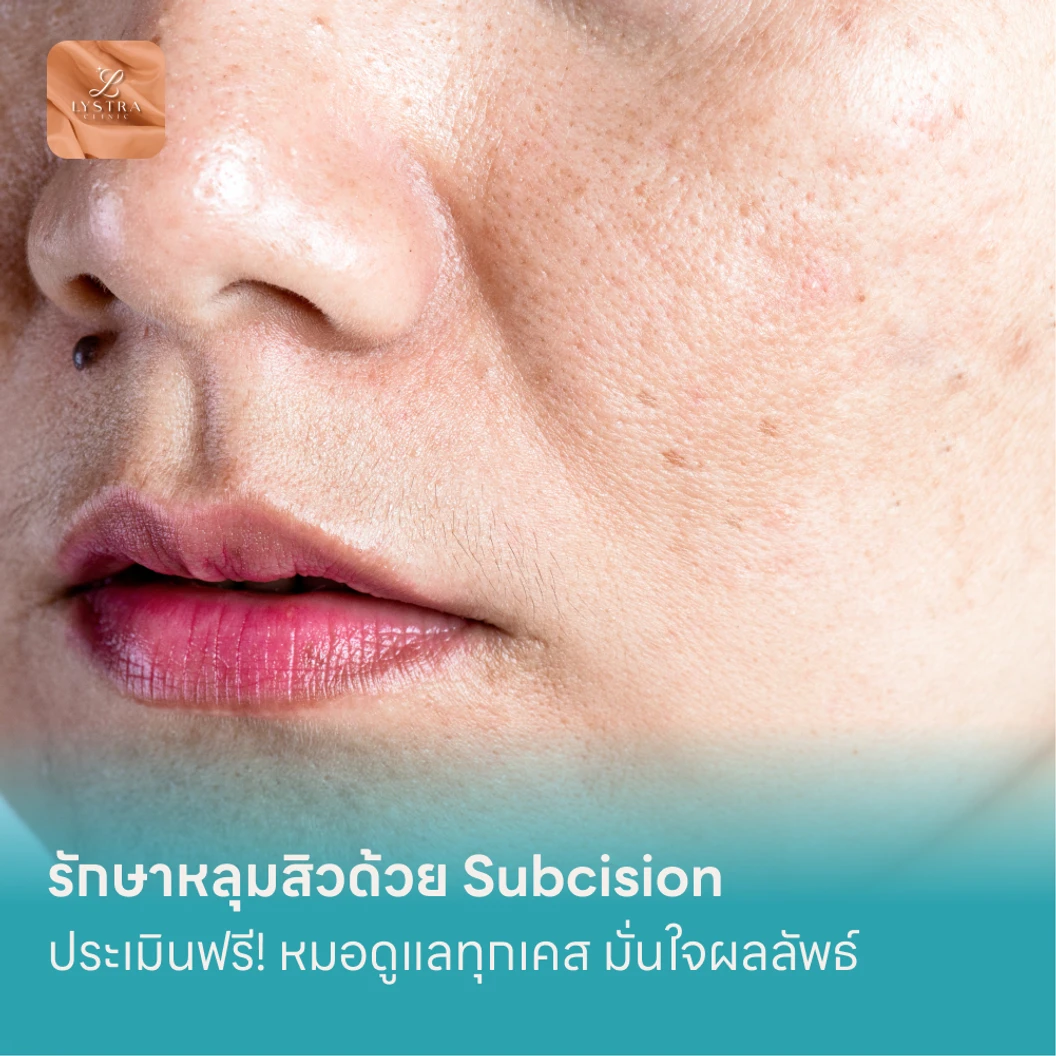 รักษาหลุมสิวด้วย Subcision แพ็กเกจ HDmall+ ที่ Lystra Clinic ลิสตร้าคลินิก