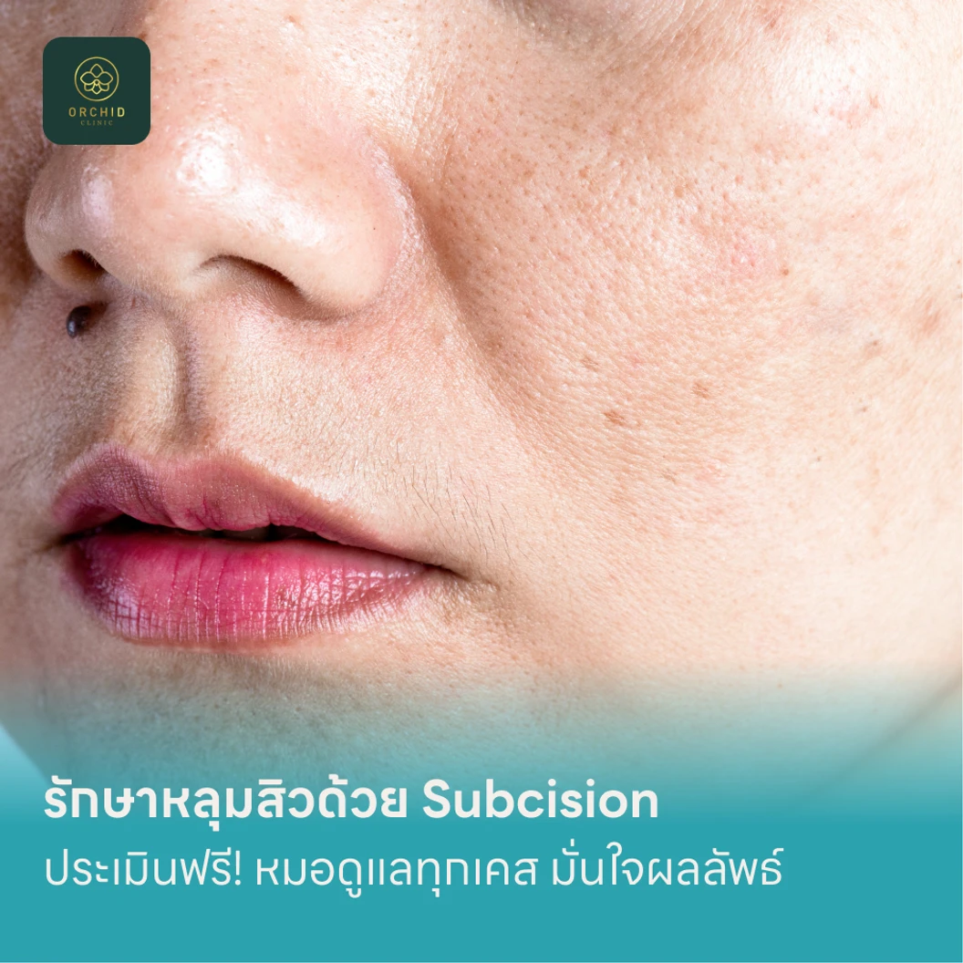 รักษาหลุมสิวด้วย Subcision แพ็กเกจ HDmall+ ที่ Orchid Clinic