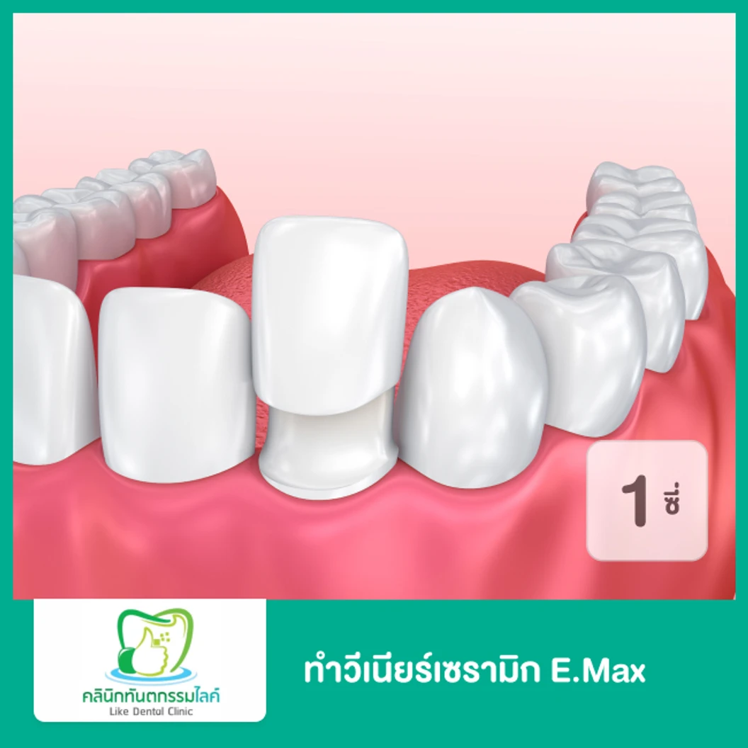 ทำวีเนียร์เซรามิก E.Max สำหรับฟัน 1 ซี่ ที่ Like Dental Clinic