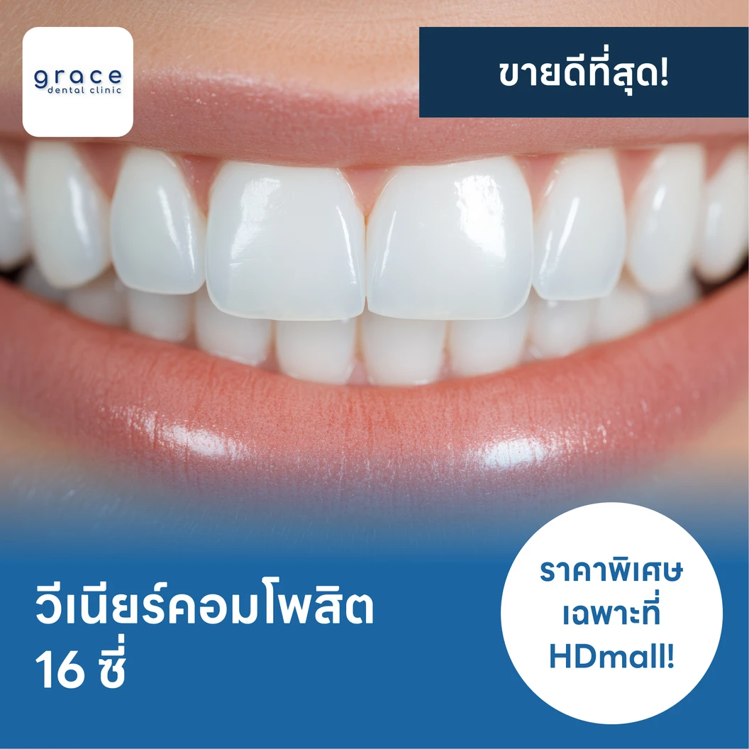 ทำวีเนียร์คอมโพสิต 16 ซี่ แพ็กเกจ HDcare Lite ที่ Grace Dental Clinic