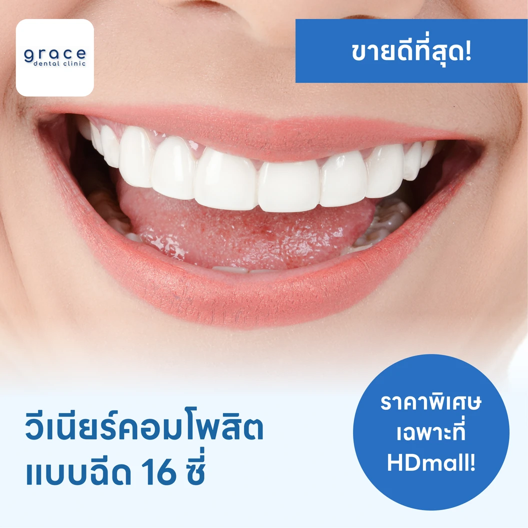 ทำวีเนียร์คอมโพสิตแบบฉีด 16 ซี่ แพ็กเกจ HDcare Lite ที่ Grace Dental Clinic