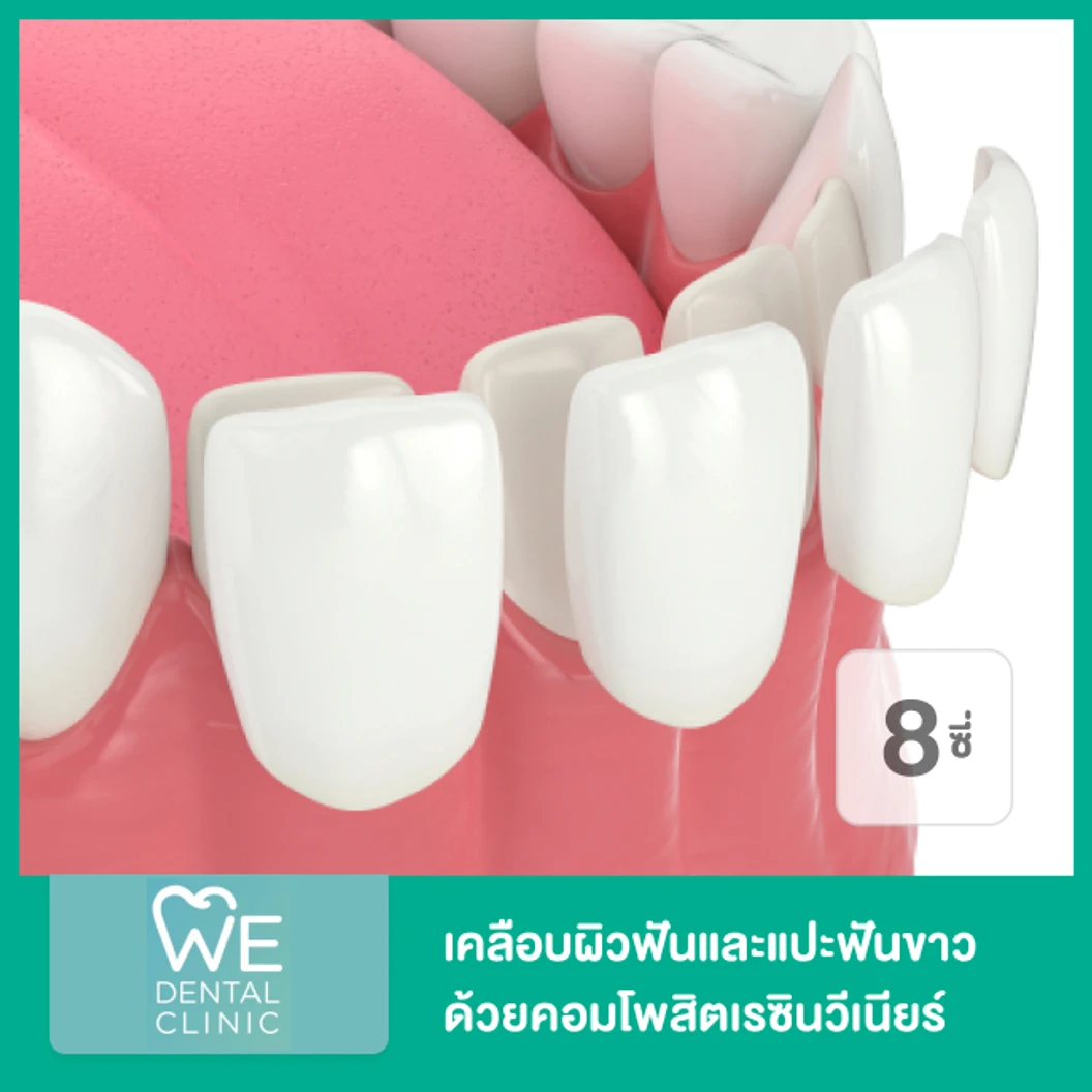 เคลือบผิวฟันและแปะฟันขาว ด้วยคอมโพสิตเรซินวีเนียร์ 8 ซี่ ที่ WE Dental Clinic