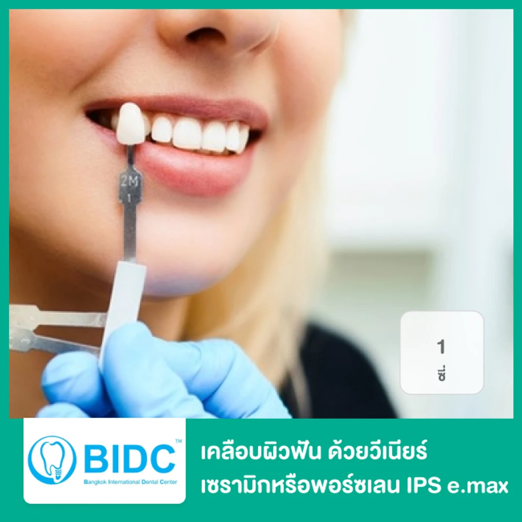 เคลือบผิวฟันและแปะฟันขาว ด้วยวีเนียร์เซรามิกหรือพอร์ซเลน IPS e.max 1 ซี่ ที่ BIDC Dental Center BIDC