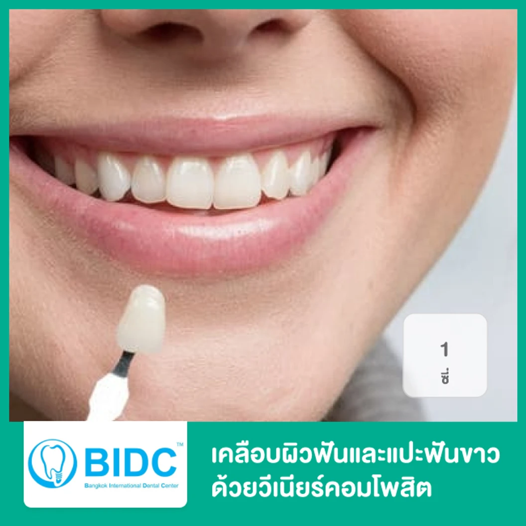 เคลือบผิวฟันและแปะฟันขาว ด้วยวีเนียร์คอมโพสิต 1 ซี่  ที่ BIDC Dental Center BIDC