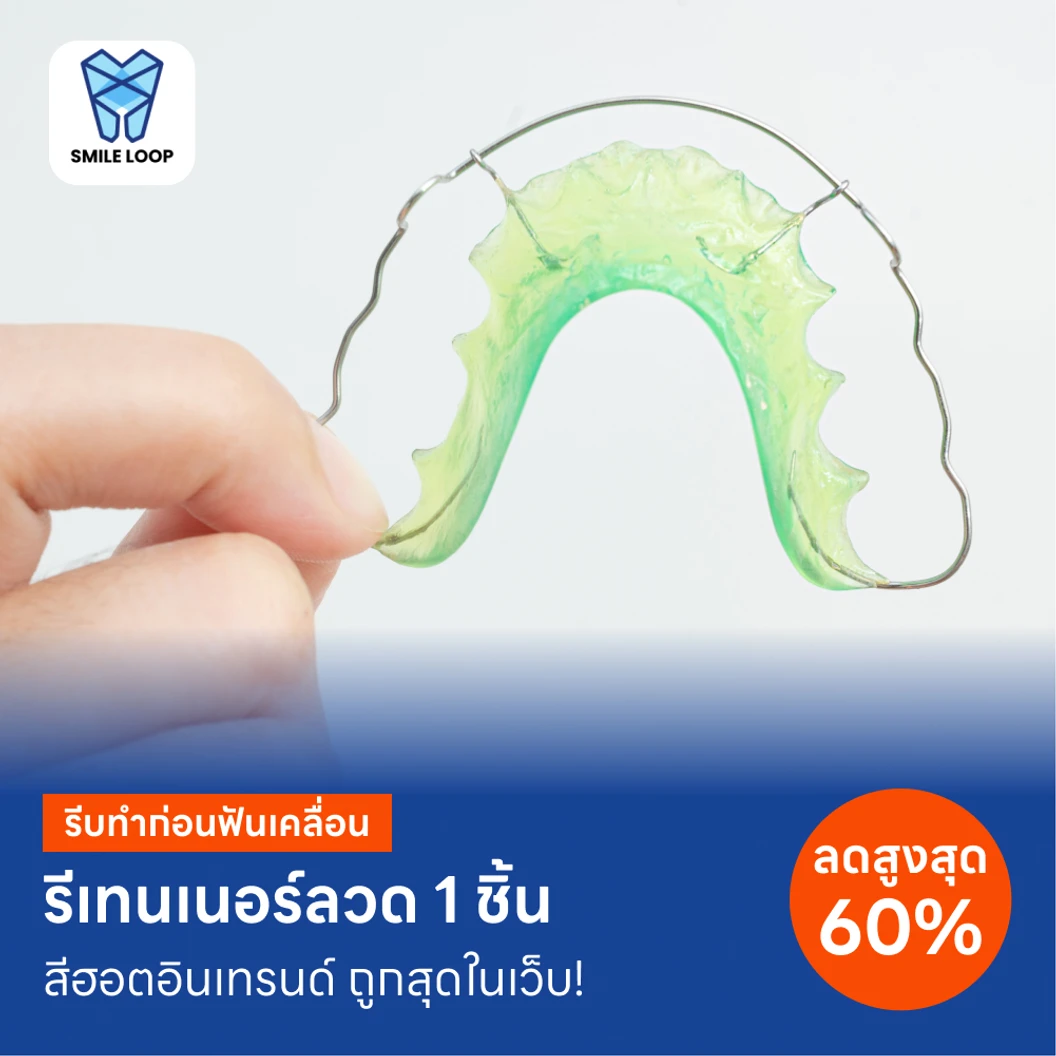 ทำรีเทนเนอร์แบบลวด 1 ชิ้น ฟันบนหรือล่าง แพ็กเกจ HDmall+ ที่ SMILE LOOP dental clinic คลินิกทันตกรรมสไมล์ลูป
