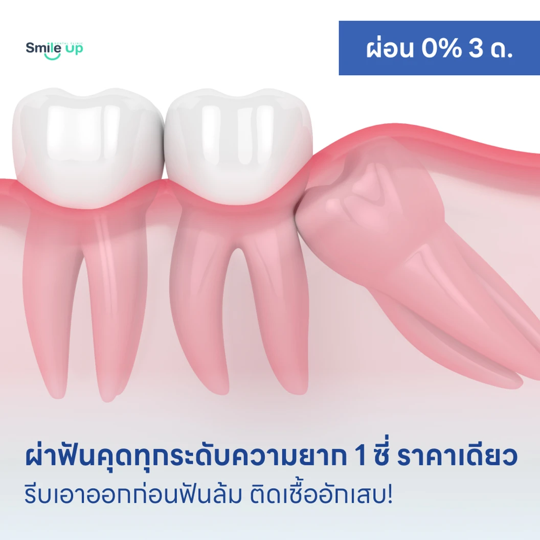 ผ่าฟันคุดทุกระดับความยาก 1 ซี่ ราคาเดียว แพ็กเกจ HDmall+ ที่ Smile Up Dental Clinic คลินิกทันตกรรมสมายล์อัพ