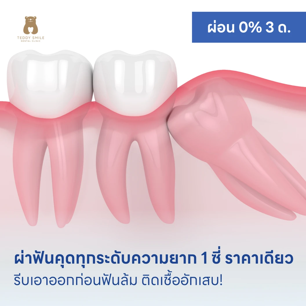 ผ่าฟันคุดทุกระดับความยาก 1 ซี่ ราคาเดียว แพ็กเกจ HDmall+ ที่ TEDDY SMILE DENTAL
