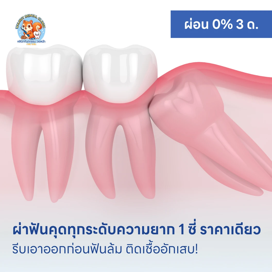 ผ่าฟันคุดทุกระดับความยาก 1 ซี่ ราคาเดียว แพ็กเกจ HDmall+ ที่ Walnut Dental Clinic คลินิกทันตกรรม วอลนัท