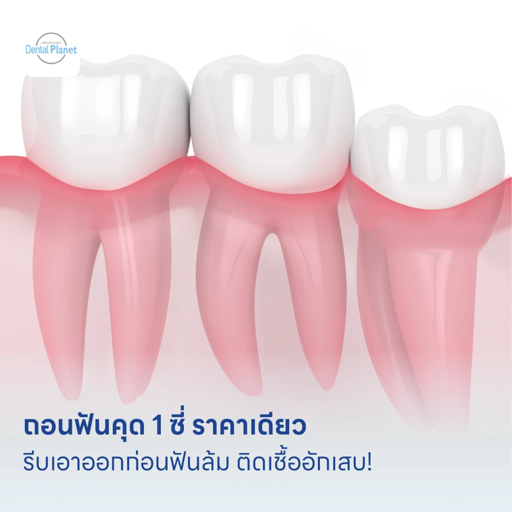 ถอนฟันคุด 1 ซี่ ราคาเดียว แพ็กเกจ HDmall+ ที่ Dental Planet Clinic