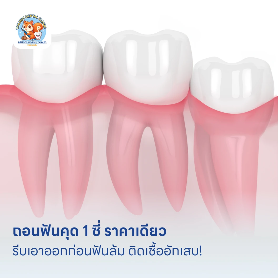 ถอนฟันคุด 1 ซี่ ราคาเดียว แพ็กเกจ HDmall+ ที่ Walnut Dental Clinic คลินิกทันตกรรม วอลนัท