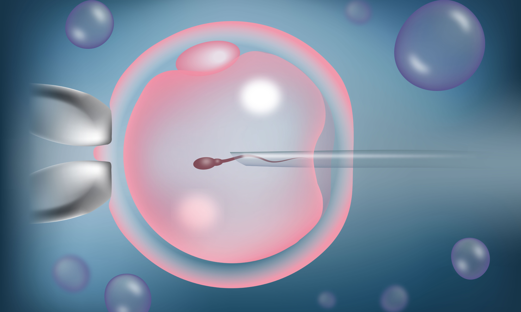 icsi process for infertility