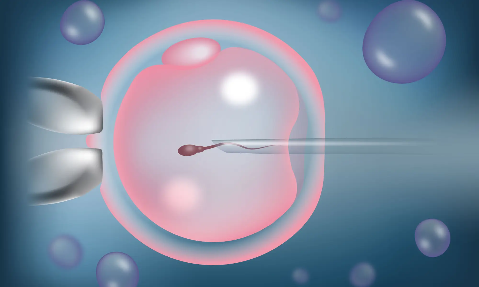 icsi process for infertility
