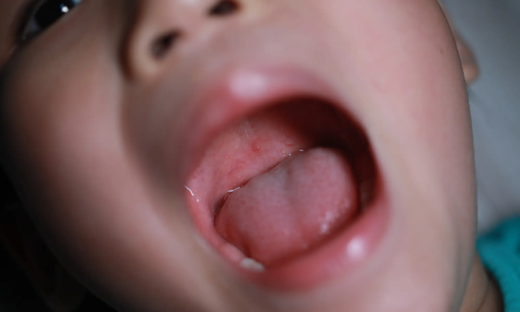blisters mouth ulcers hfmd disease definition