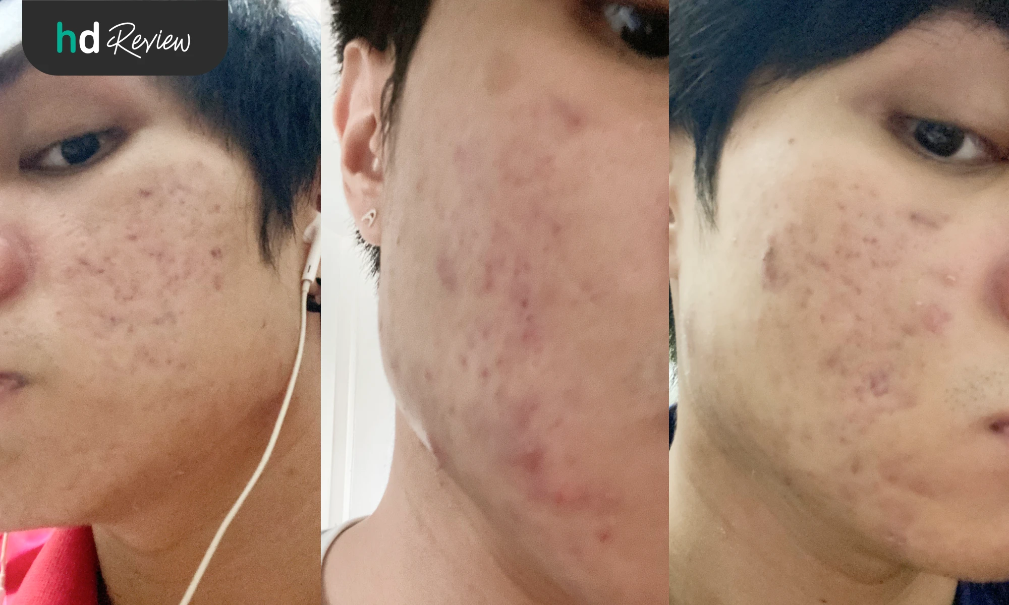 หลุมสิว