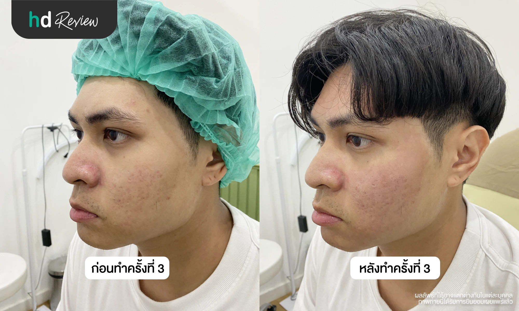 ผลลัพธ์หลังรักษาหลุมสิวครั้งที่ 3