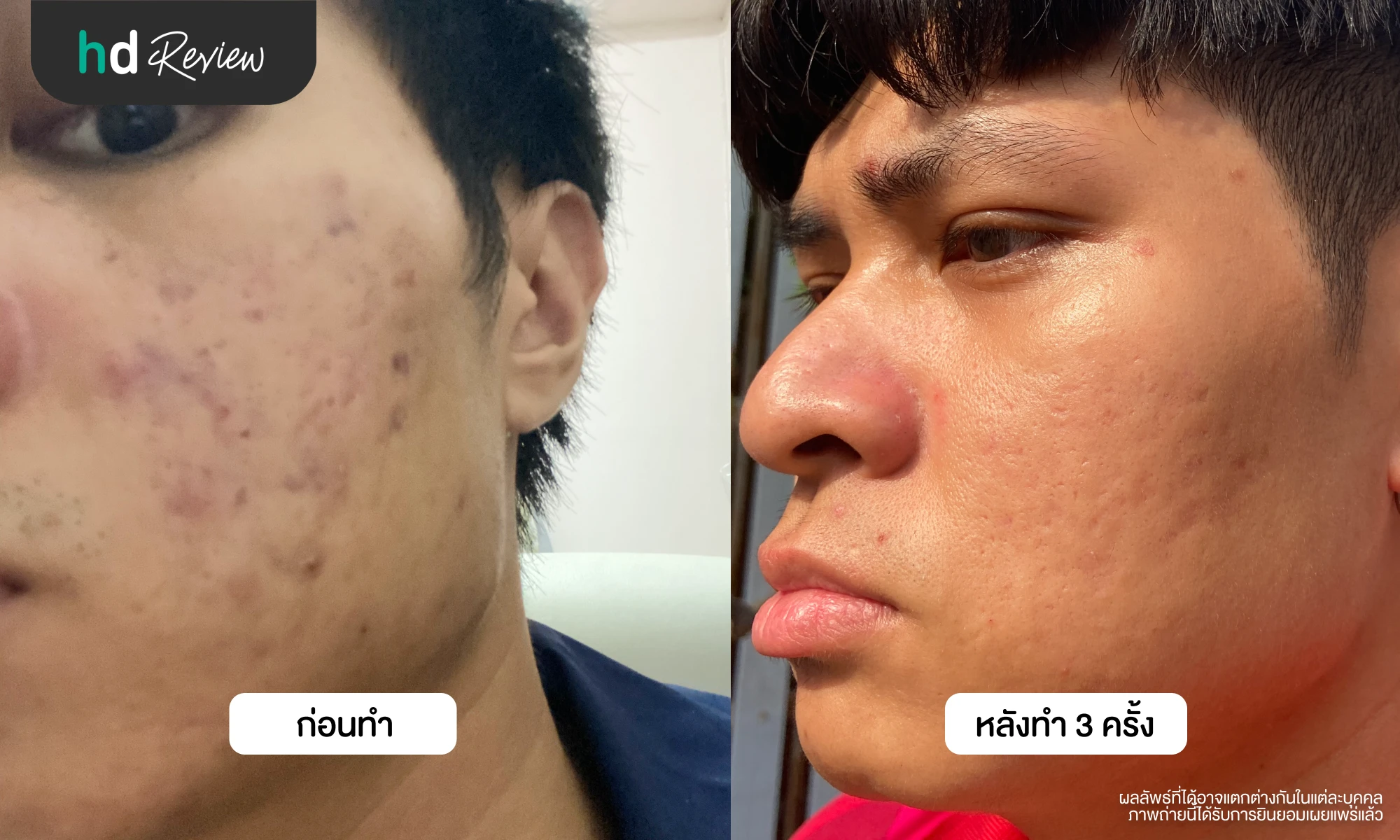 ผลลัพธ์หลังทำ Derma Pen