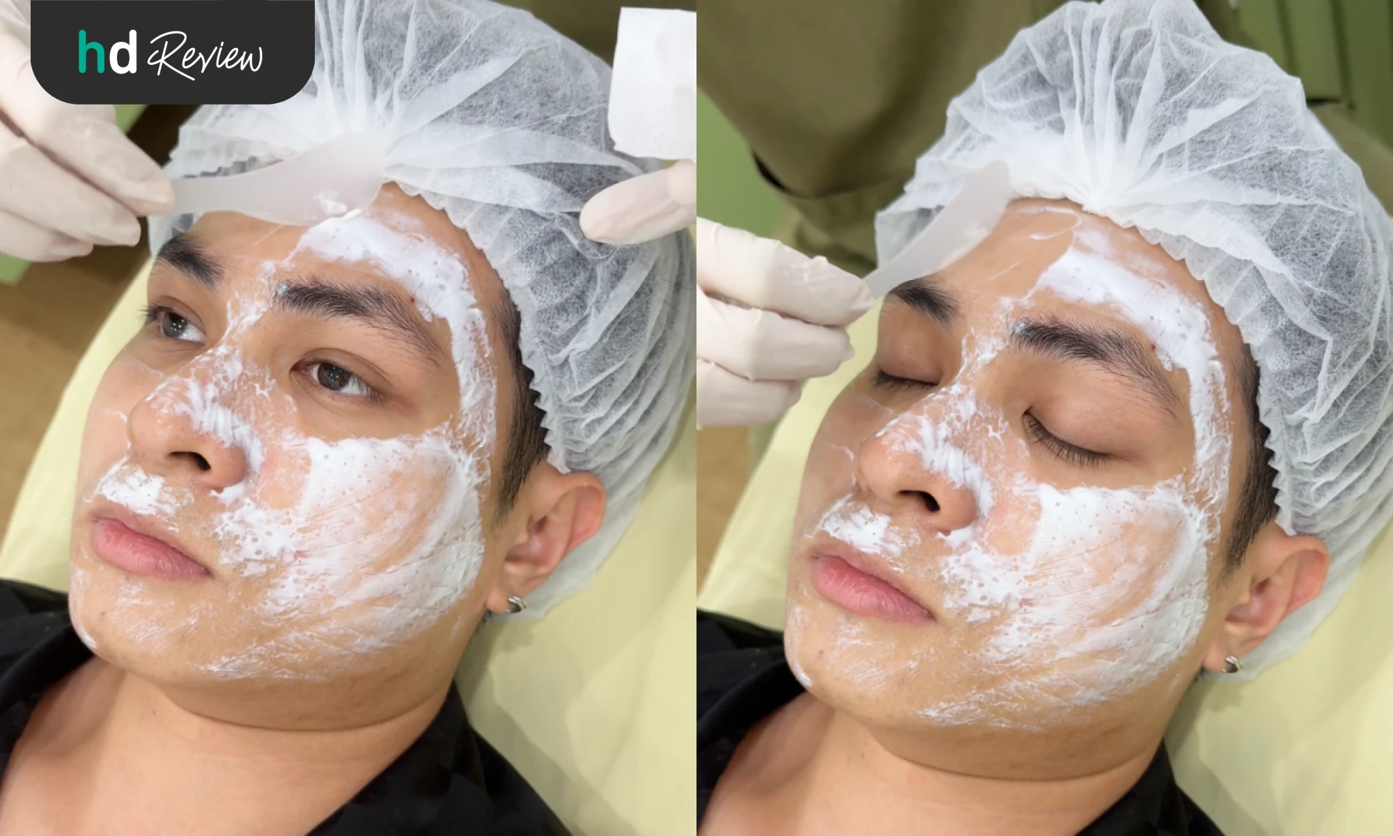 Derma Pen เจ็บมั้ย