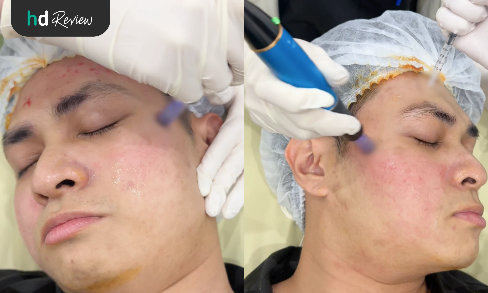 รีวิวรักษาหลุมสิว