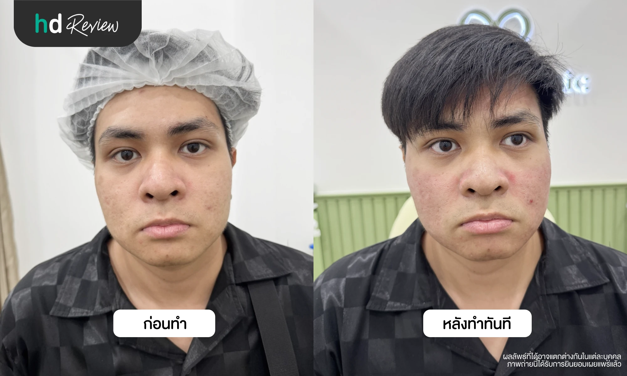 ผลลัพธ์หลังรักษาหลุมสิวครั้งที่ 1