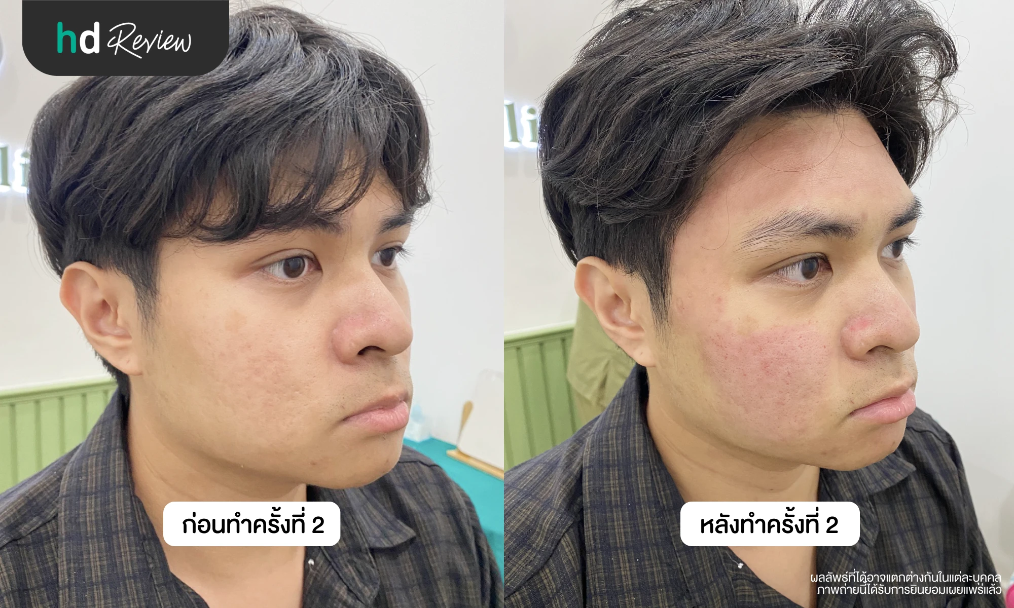 ผลลัพธ์หลังรักษาหลุมสิวครั้งที่ 2