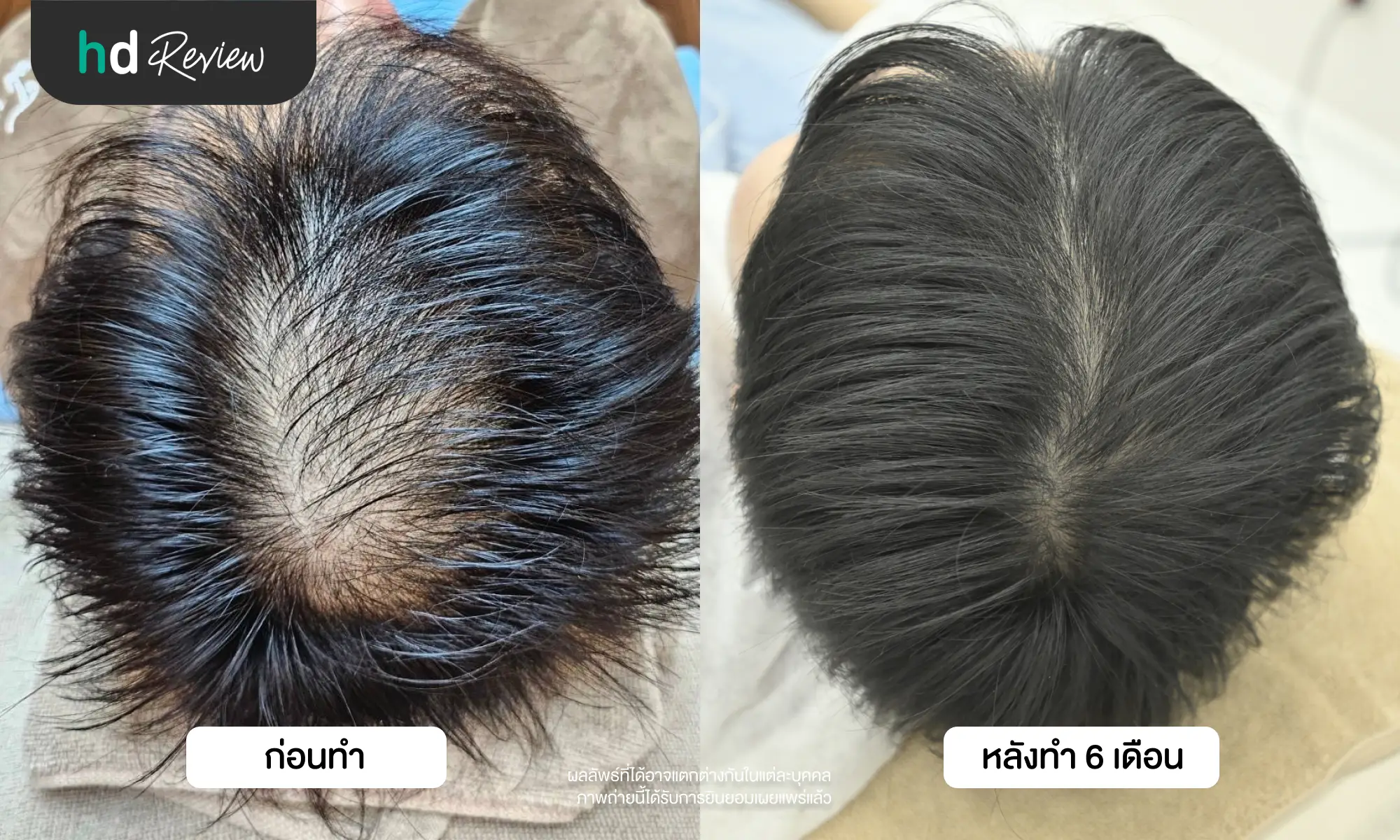 รีวิวรักษาผมร่วง ผมบาง ภายใน 4 ขั้นตอน กับ Hair Regrowth Program ที่ Wellnis Clinic 11 รีวิวรักษาผมร่วง ผมบาง