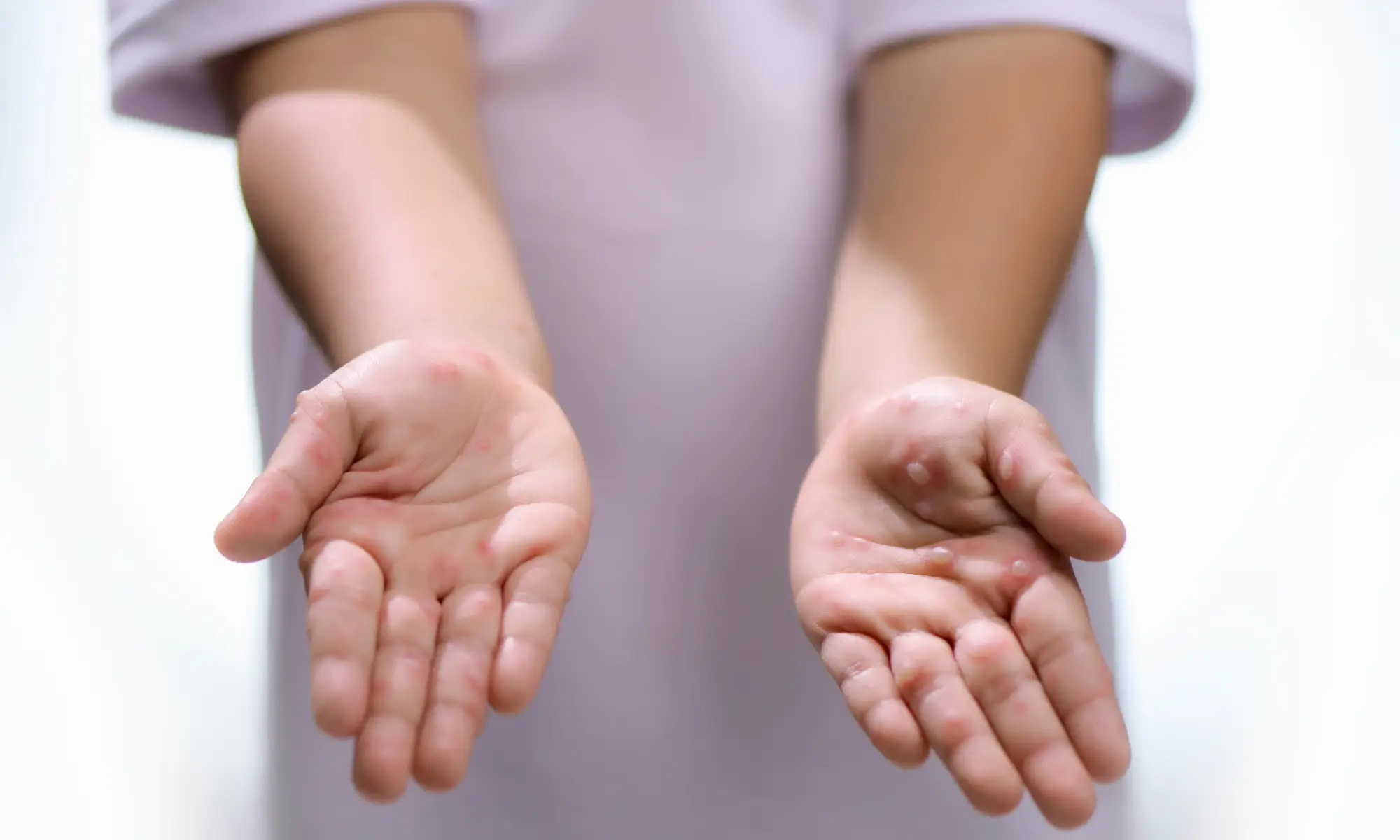 hfmd damage disease definition