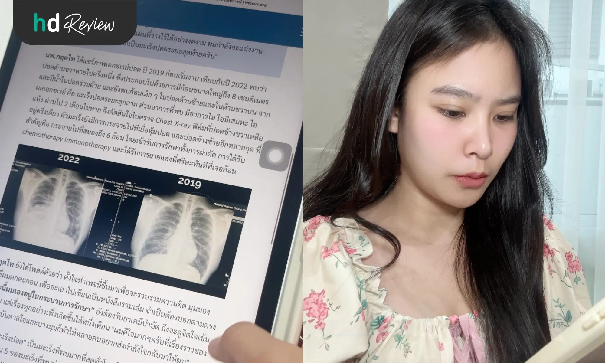 เช็กปอดให้ชัวร์! รีวิวตรวจคัดกรองมะเร็งปอด ด้วยวิธี Low-Dose CT Scan ที่ รพ. เปาโล รังสิต 3 มะเร็งปอด