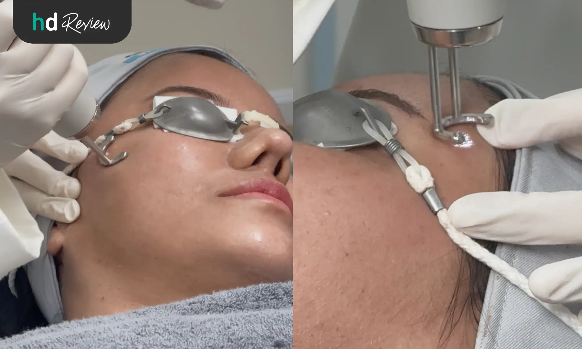 รีวิวโปรแกรม Discovery Pico Laser แก้ปัญหาผิวหน้าไม่เรียบเนียน ที่ Laliza Clinic 7 รีวิว Discovery Pico Laser