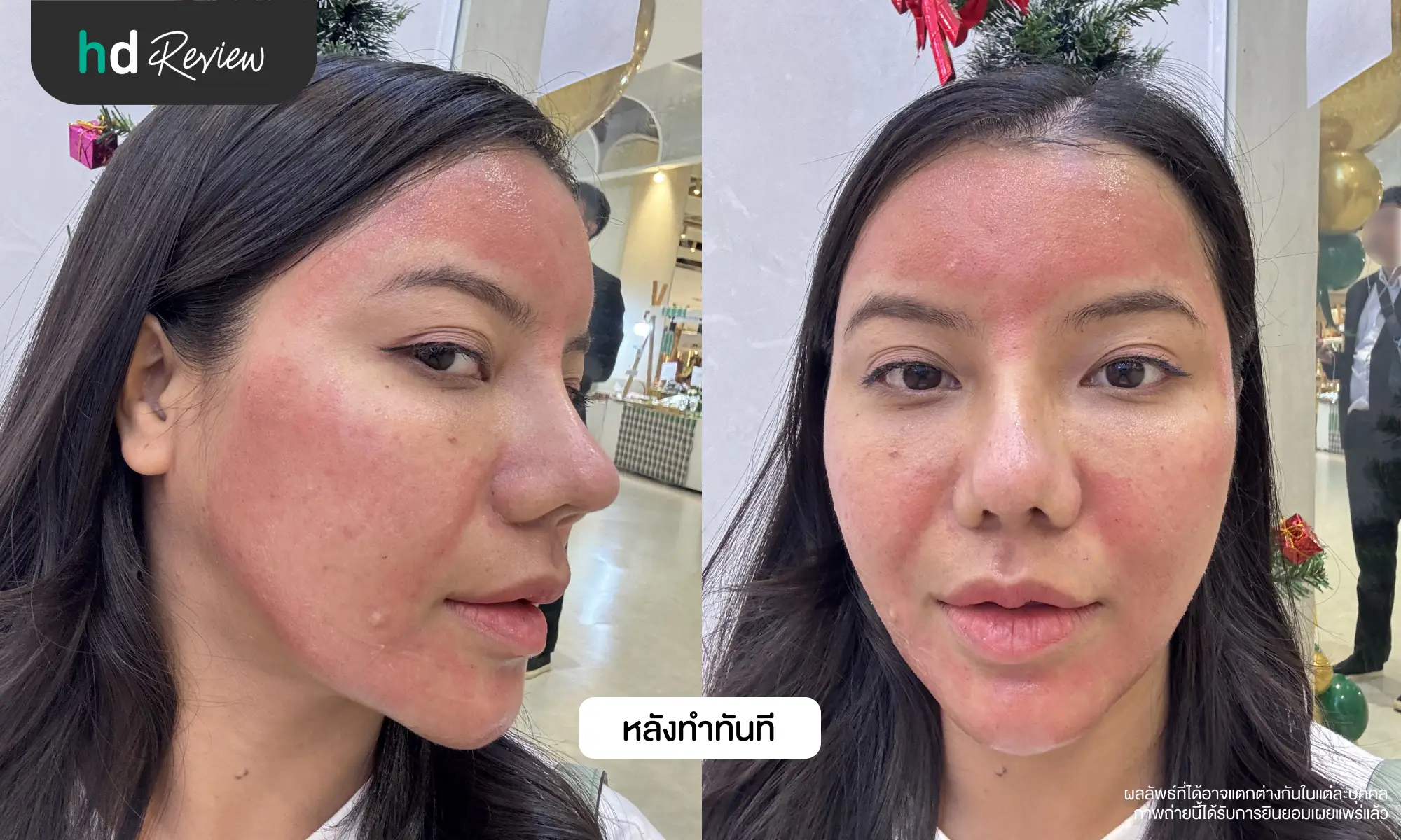 รีวิวโปรแกรม Discovery Pico Laser แก้ปัญหาผิวหน้าไม่เรียบเนียน ที่ Laliza Clinic 8 Pico Laser หน้าแดงกี่วัน