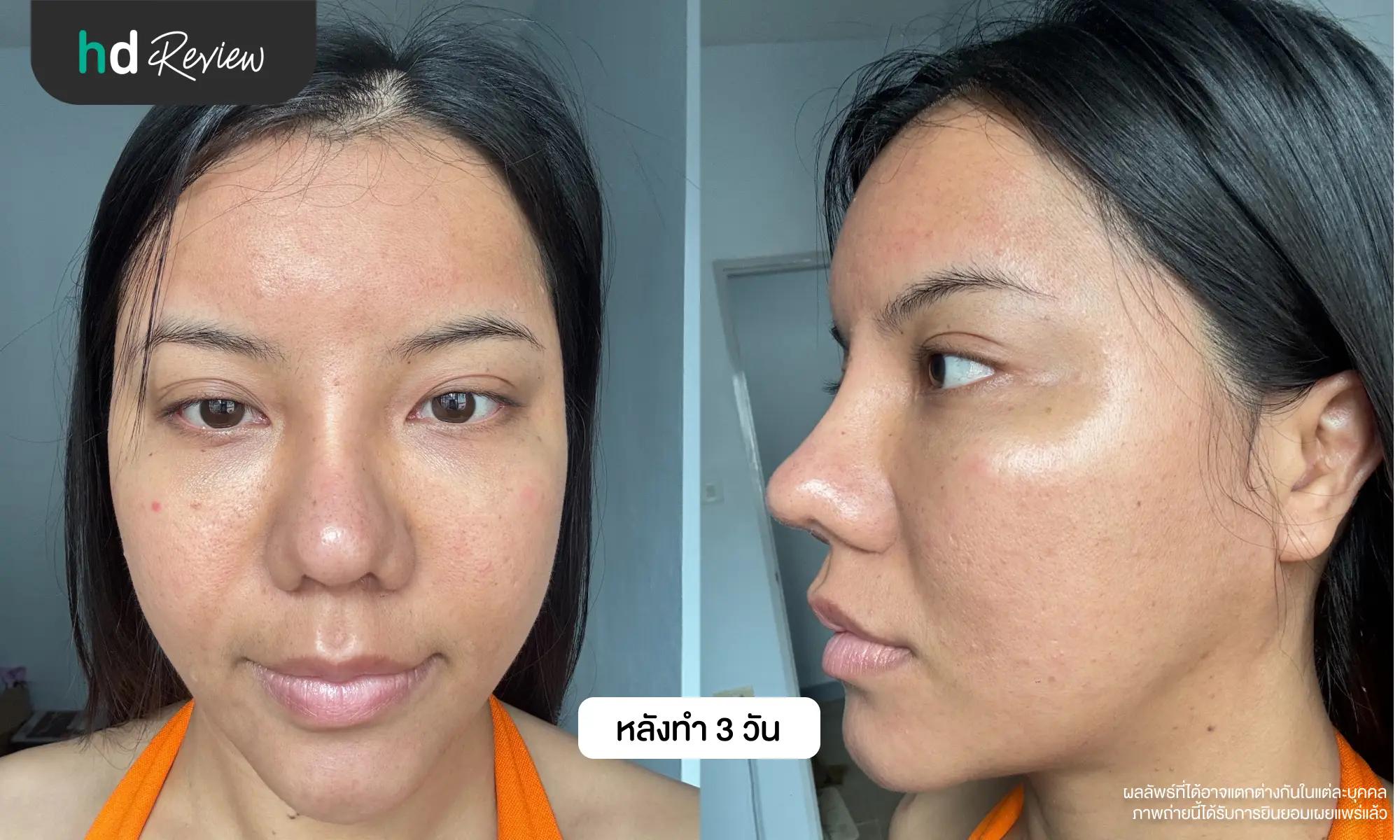 รีวิวโปรแกรม Discovery Pico Laser แก้ปัญหาผิวหน้าไม่เรียบเนียน ที่ Laliza Clinic 9 ผลลัพธ์หลังทำ Discovery Pico Laser