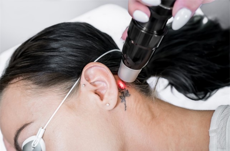 ทำเลเซอร์ Q-Switch ลบรอยสักขนาด 2x2 นิ้ว 1 ครั้ง ที่ Divine Aesthetic Clinic