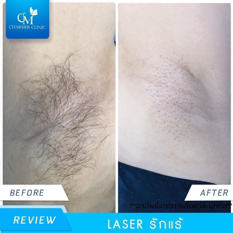 กำจัดขนรักแร้ด้วย IPL + มาส์กผิวให้ดูกระจ่างใส 1 ครั้ง ที่ Charmer Clinic