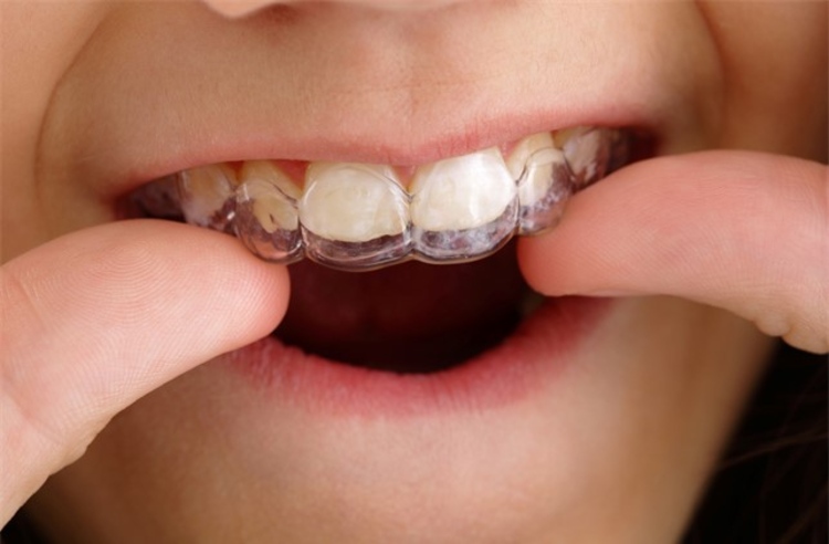 คอร์สจัดฟันแบบใส ClearSmile ฟันบนและล่าง ที่ BFC Dental (บ้านฟันสวย)