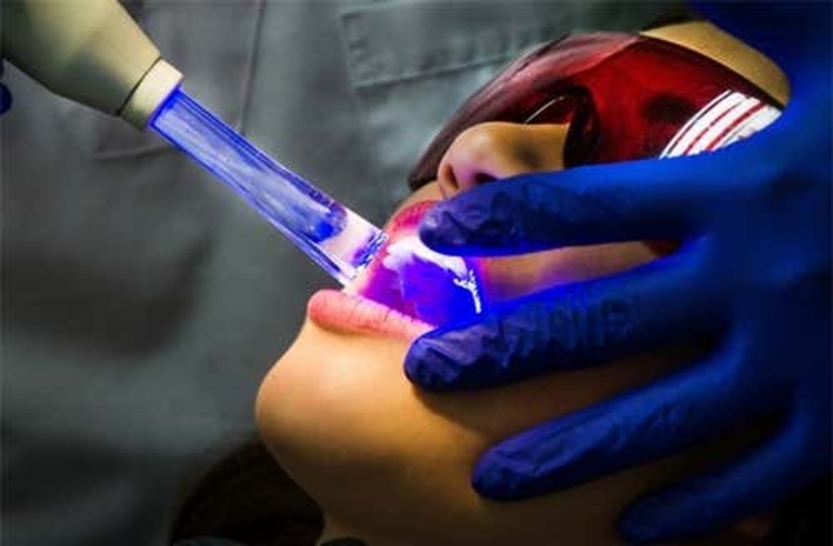 ฟอกสีฟัน ด้วยระบบ Cool light ที่ We Smile Dental Clinic