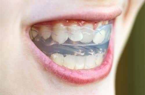 คอร์สจัดฟันแบบใส Invisalign Full (Moderate/Comprehensive) ฟันบนและล่าง ที่ Deezy Dental Home