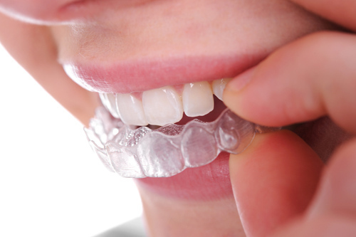 คอร์สจัดฟันแบบใส Clear Aligner 1 เซ็ต ฟันบนหรือล่าง (แล็บไทย) ที่ Deezy Dental Home