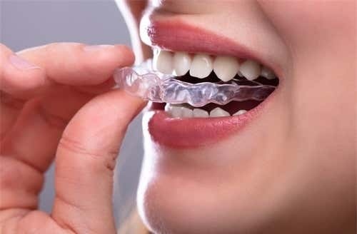 คอร์สจัดฟันแบบใส Invisalign Lite ฟันบนหรือล่าง ที่ Deezy Dental Home