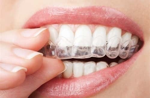 คอร์สจัดฟันแบบใส Invisalign Lite ฟันบนและล่าง ที่ Deezy Dental Home