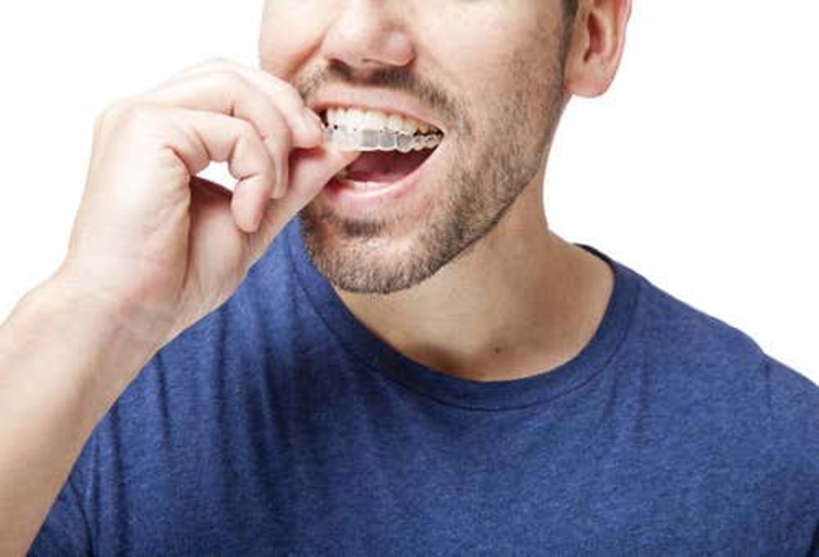 คอร์สจัดฟันแบบใส Invisalign i7 ฟันบนและล่าง ที่ LDC Dental