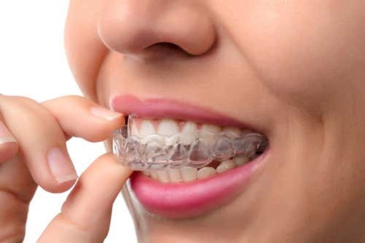 คอร์สจัดฟันแบบใส Invisalign i7 ฟันบนและล่าง ที่ Smile Society Dental (คลินิกทันตกรรมสไมล์โซไซตี้)