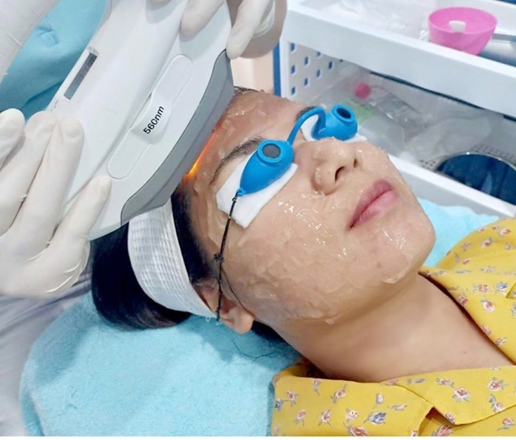 ทำ IPL ปรับสภาพผิว บริเวณใบหน้า 1 ครั้ง ที่ Charmer Clinic