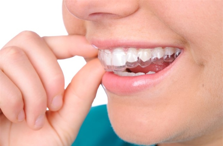 คอร์สจัดฟันแบบใส ClearSmile ฟันบนและล่าง ที่ Cleo Dent Dental Clinic