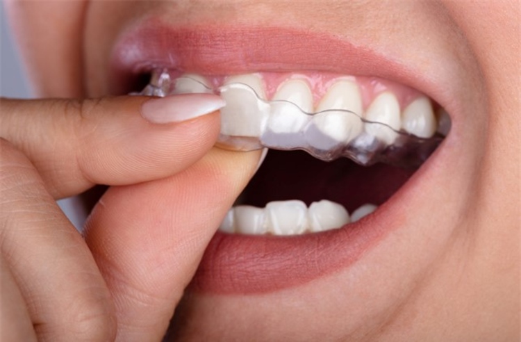 คอร์สจัดฟันแบบใส ClearSmile ฟันบนและล่าง ที่ ศูนย์จัดฟัน รากเทียม บูทีคเด็นทัล