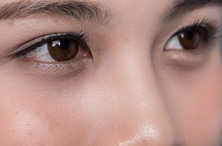 ฉีดฟิลเลอร์สวีเดน Restylane บริเวณใต้ตา 1 ซีซี 1 ครั้ง ที่ Millennium Anti Aging Clinic