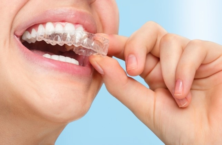 คอร์สจัดฟันแบบใส Invisalign Moderate ฟันบนและล่าง ที่ The Crystal Dental Clinic