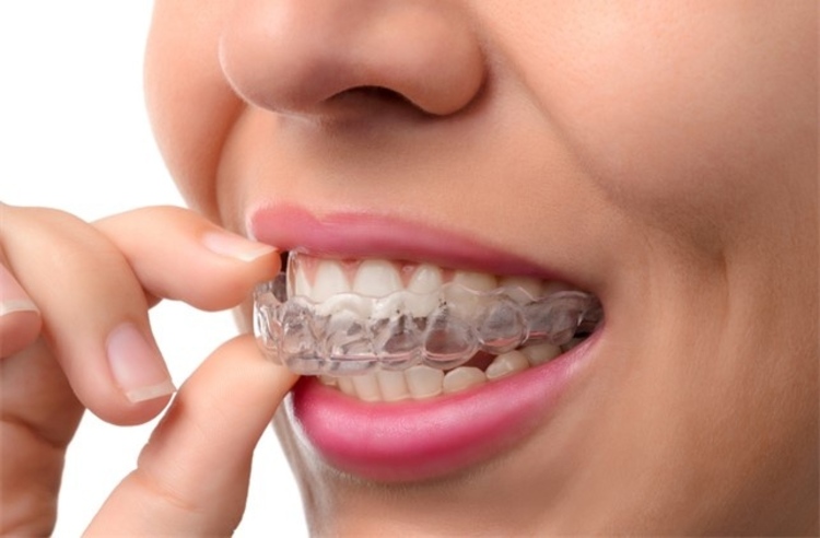 คอร์สจัดฟันแบบใส Invisalign Full Comprehensive ฟันบนและล่าง ที่ The Crystal Dental Clinic