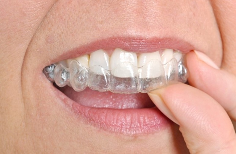 คอร์สจัดฟันแบบใส Invisalign Moderate ฟันบนและล่าง ที่ Zense Smile