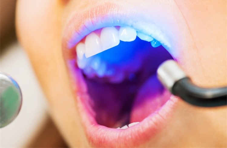 ฟอกสีฟัน ด้วยระบบ Cool Light พร้อมขูดหินปูน ที่ Smile Plus Dental Clinic