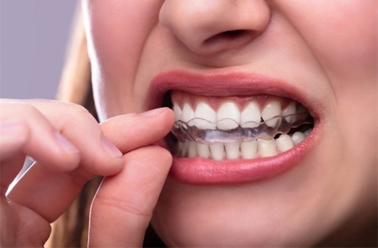 คอร์สจัดฟันแบบใส Invisalign Full Comprehensive ฟันบนและล่าง ที่ We Smile Dental Clinic